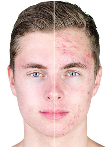 Before and after of acne on mans face